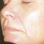 Laser Facial After